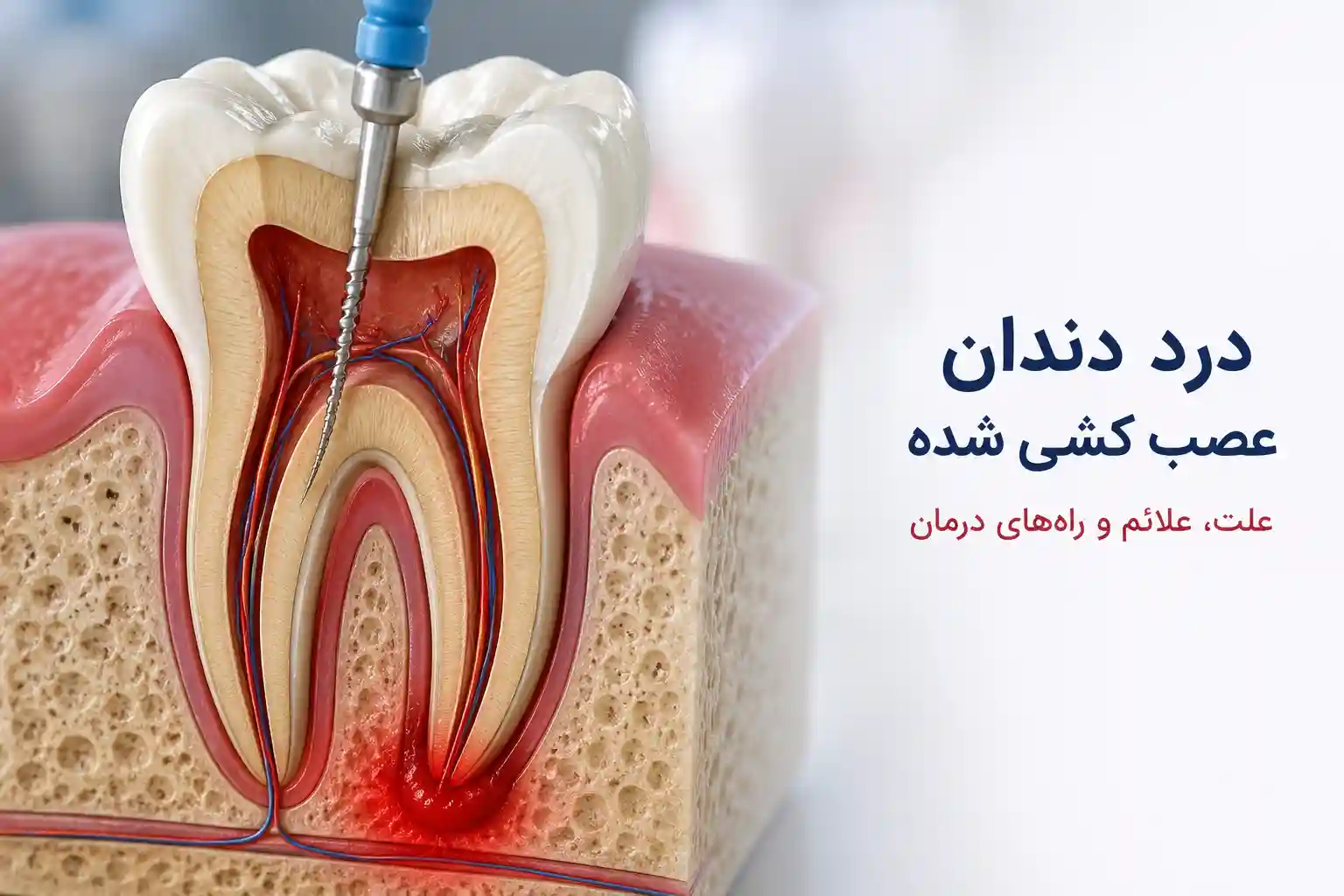 درد دندان عصب کشی شده