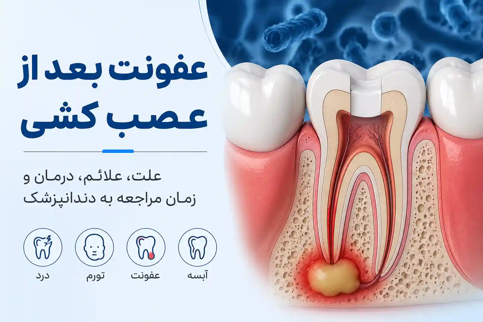 عفونت بعد از عصب کشی