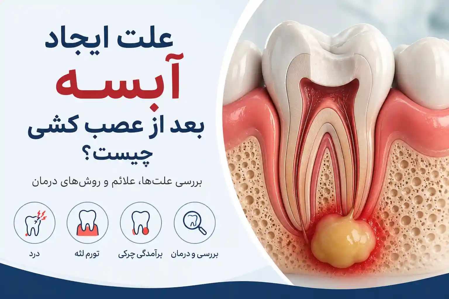 علت ایجاد آبسه بعد از عصب کشی چیست؟